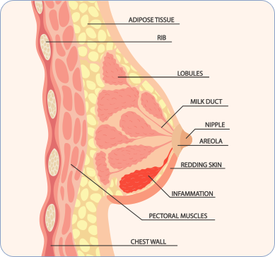 유방 결절이 뭐예요? 유방암이요?